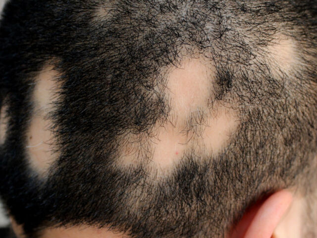 Banner Alopecia