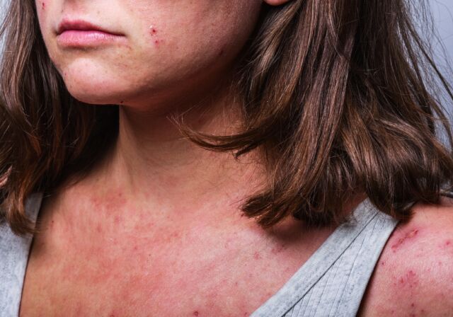 Selective,focus.,a,young,girl,with,atopic,dermatitis,in,the